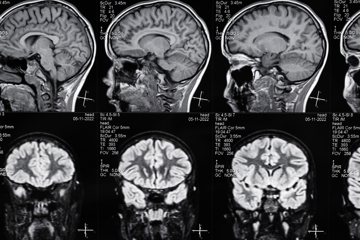 Brain scans.